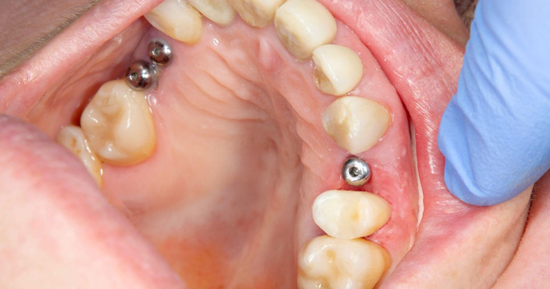 sleep-for-dental-implants.jpeg