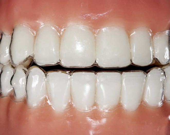 ortodoncia-invisalign-sant-cugat.jpeg