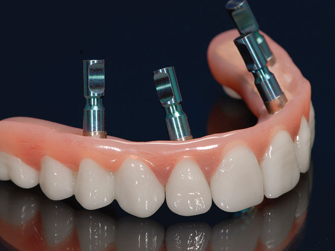 All-on-4-hybrid-titanium-frame-zirconia-teeth-top.jpeg