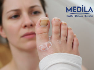 Mantar Enfeksiyonunu Önlemenin Etkili Yolları