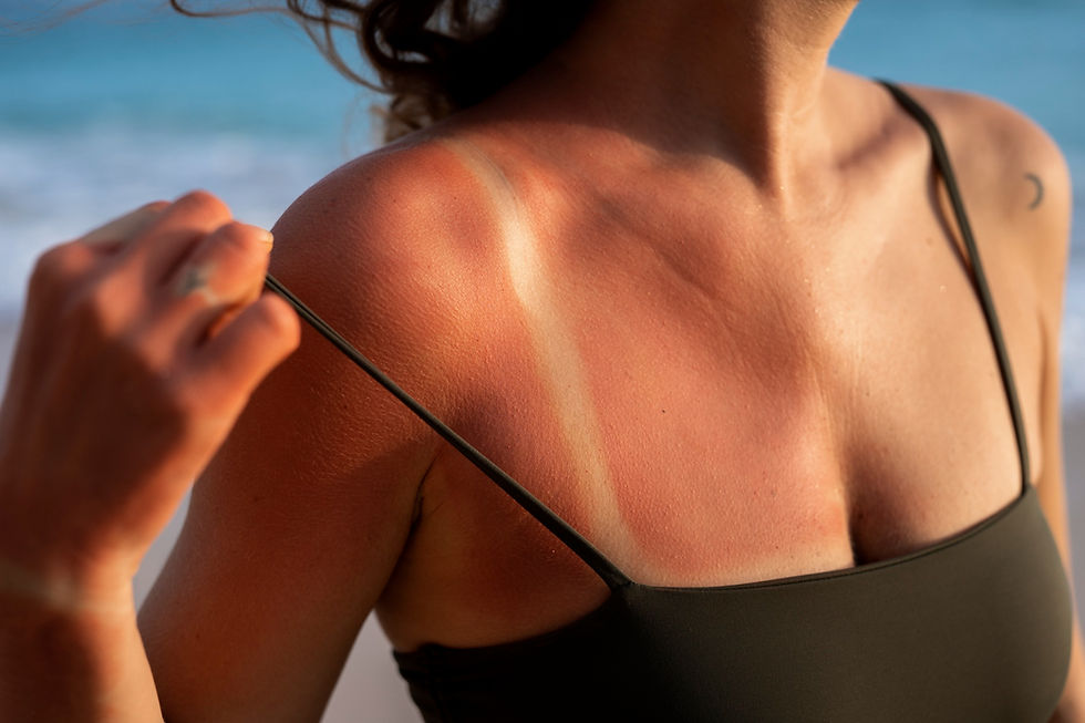 After Sun Περιποίηση: Οδηγός για Ήπια Ανάπλαση Δέρματος μετά από Έκθεση στον Ήλιο