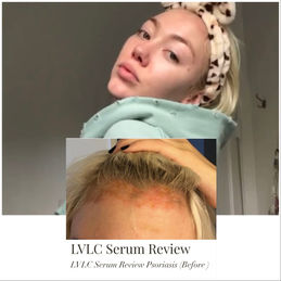 Psoriasis before and After