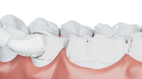 Ontdek de nieuwe generatie fluoridebehandelingen!