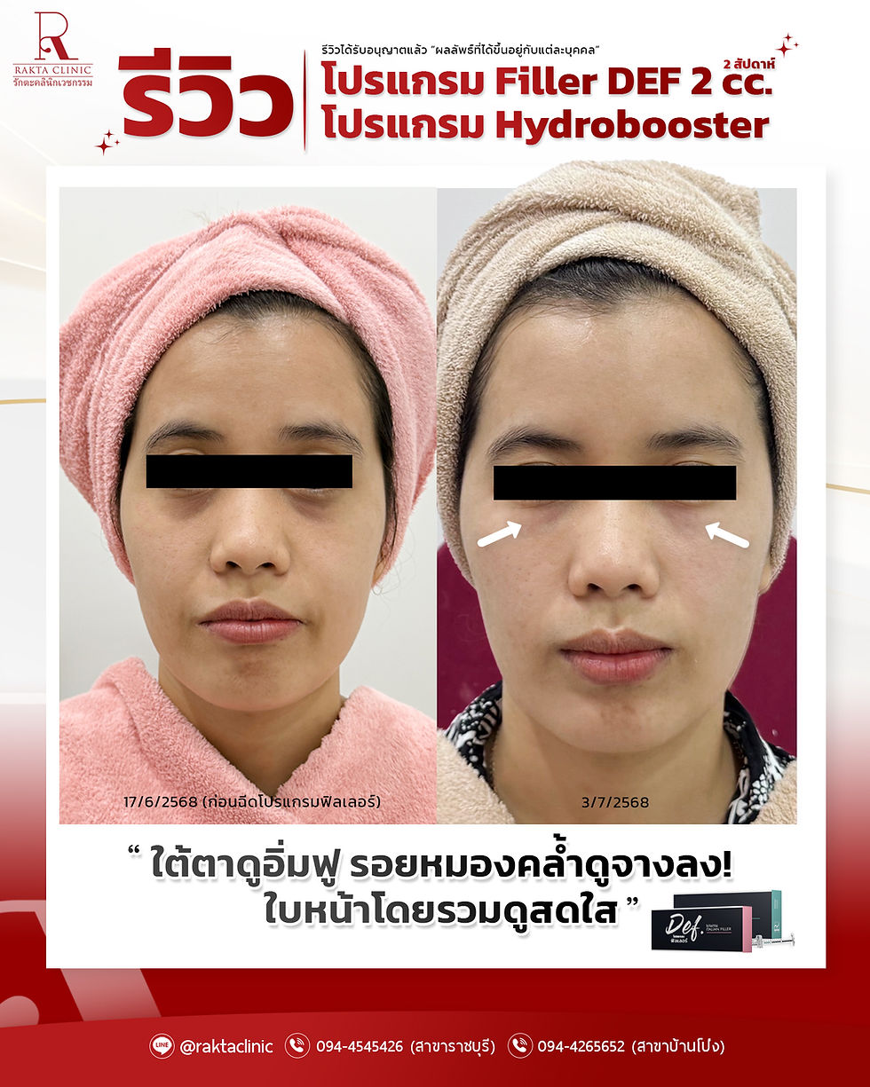 รีวิวโปรแกรมฉีด Filler (สารเติมเต็ม) + Hydrobooster (กระตุ้นการสร้างคอลลาเจน)