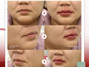 💋CEO ไม่ได้มีแค่ Business Plan…Lip Plan ก็ต้องมี | รีวิวโปรแกรม ฉีดฟิลเลอร์ปาก 1 cc. รักตะคลินิก