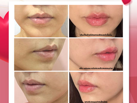 🫦ปากน่าจุ๊ฟ...แบบนี้ คุณสามีจะอดใจไหวหรอคะ~ รีวิว (โปรแกรม) ฉีดฟิลเลอร์ปาก  เปลี่ยนลุค Sexy เซอร์ไพรส์คุณสามีไปเลยค่ะ💉💃