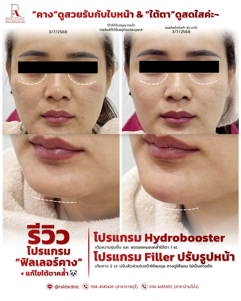 รีวิว (โปรแกรม) ฉีดฟิลเลอร์คาง & กระตุ้นการสร้างคอลลาเจนใต้ตา