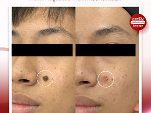 ไฝเม็ดนี้อยู่กับเรามาหลายปี! ตอนนี้ Move on แล้วค่ะ...Review โปรแกรมดูแลไฝ #รักตะคลินิก รายละเอียดเล็กๆ ที่เราใส่ใจ~