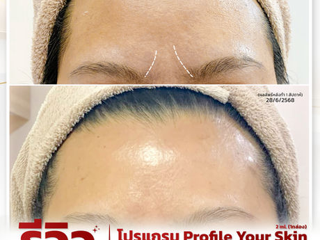 🌷ผิวดูดี ดูเรียบเนียน ไม่ใช่เรื่องบังเอิญ~ แต่...เป็นผลจากการดูแลแบบตั้งใจ รีวิว (โปรแกรม) Profile Your Skin💉