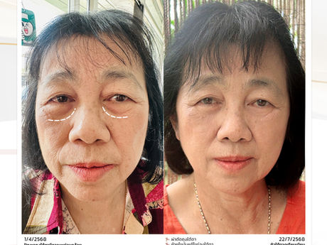 มอบของขวัญ “วันแม่” ที่มากกว่าดอกมะลิ...รีวิว ผ่าตัดถุงใต้ตา & ย้ายไขมันแก้ไขร่องใต้ตา #คุณแม่ อายุ 66 ปี~