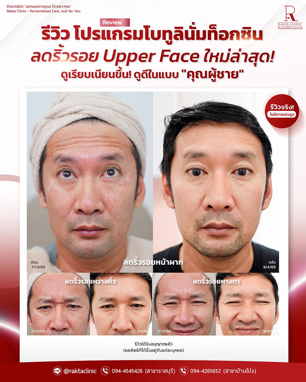 😘คุณภรรยาเห็นภาพนี้...นัดคิวให้คุณสามีได้เลยค่ะ รีวิวโปรแกรมฉีดโบทูลินั่มท็อกซิน ลดริ้วรอย Upper face "เคสคุณผู้ชาย" | รักตะคลินิก