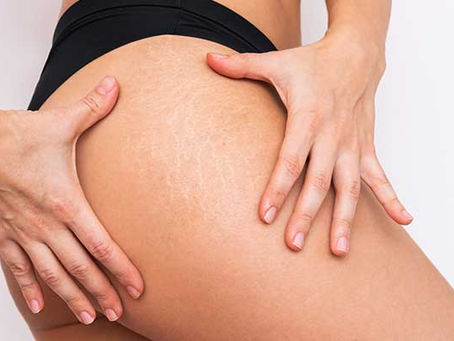 Comment prévenir les vergetures en étant enceinte ? 