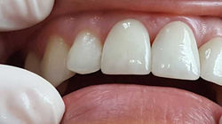 Estética Dental | Odontoríe