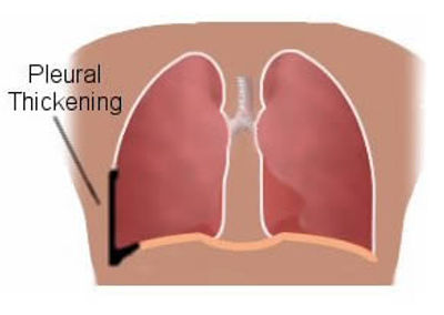 Pleural Thickening Symptoms, Causes And Treatment, 48% OFF