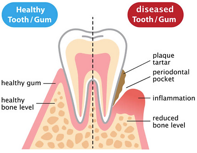 Healthy tooth and gum vs Diseased tooth and gum diagram