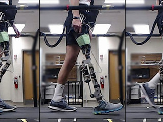 Prótese com inteligência artificial ajuda paciente a andar mais rápido