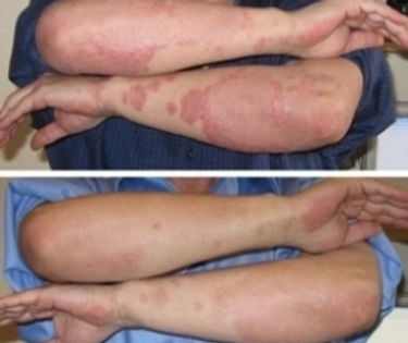 Psoriasis