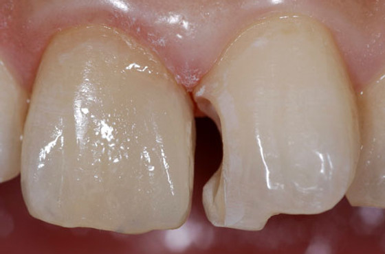 前歯2本を保険診療のコンポジットレジン Cr で治療 高坂デンタルオフィス 前歯2本を保険診療のコンポジットレジン Cr で治療 高坂デンタルオフィス
