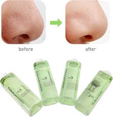Close-up of clogged pores on skin before Hydro Peel treatment.