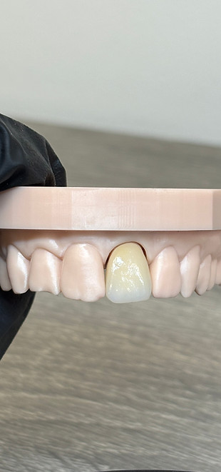 Zirconia Central Front View 1.jpeg