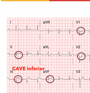 12-Kanal-EKG mit markierten Warnzeichen zur strukturierten Beurteilung des EKG-Erstbefundes.