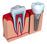 implante-dentário-vídeo-demonstrativo.jp