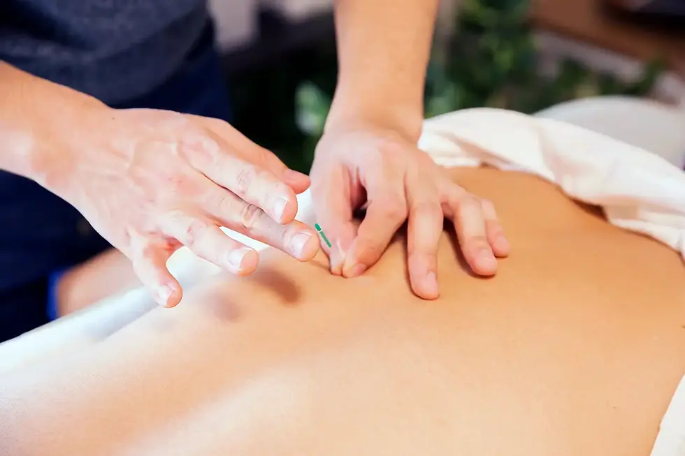 acupuncturist inserting needle into a patients back