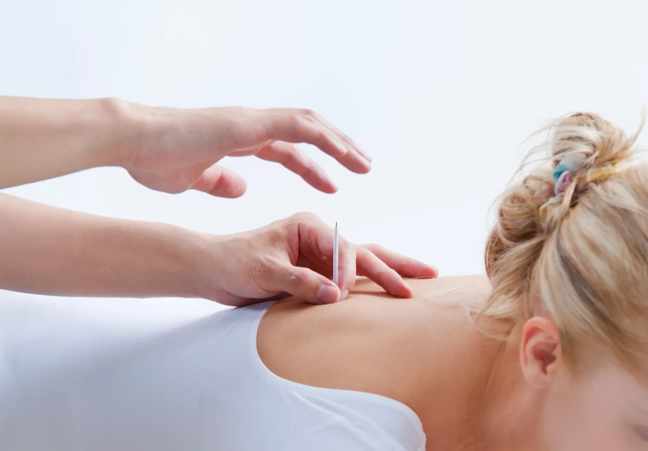 woman-having-acupuncture_edited_edited.jpg