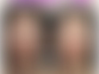 1回でも透明感アップ✨Iris3D光RFの症例をご紹介