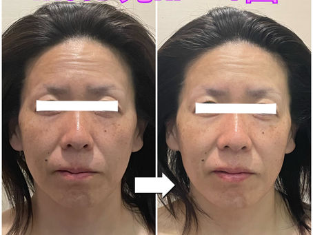 1回でも透明感アップ✨Iris3D光RFの症例をご紹介
