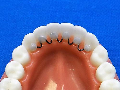 Fixed lingual wire Hygiene type
