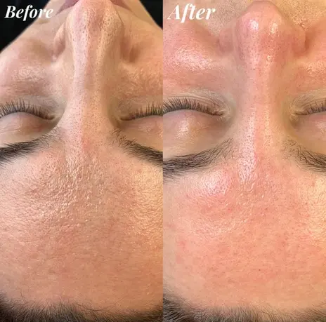 Before and After comparison of skin, with visible text, Deluxe Dermaplaning treatment results