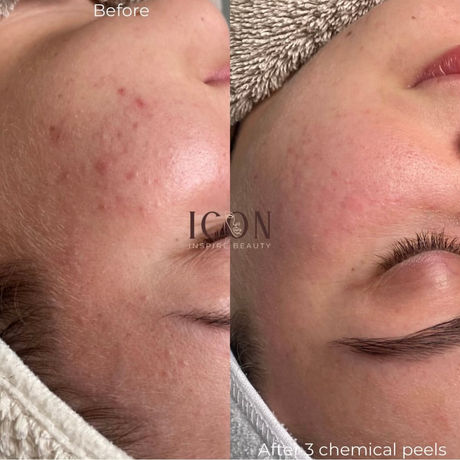Before and after face comparison with Icon, showing the results after 3 chemical peels.