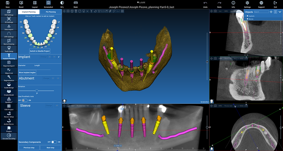 TrueGuide Digital Implant Planning