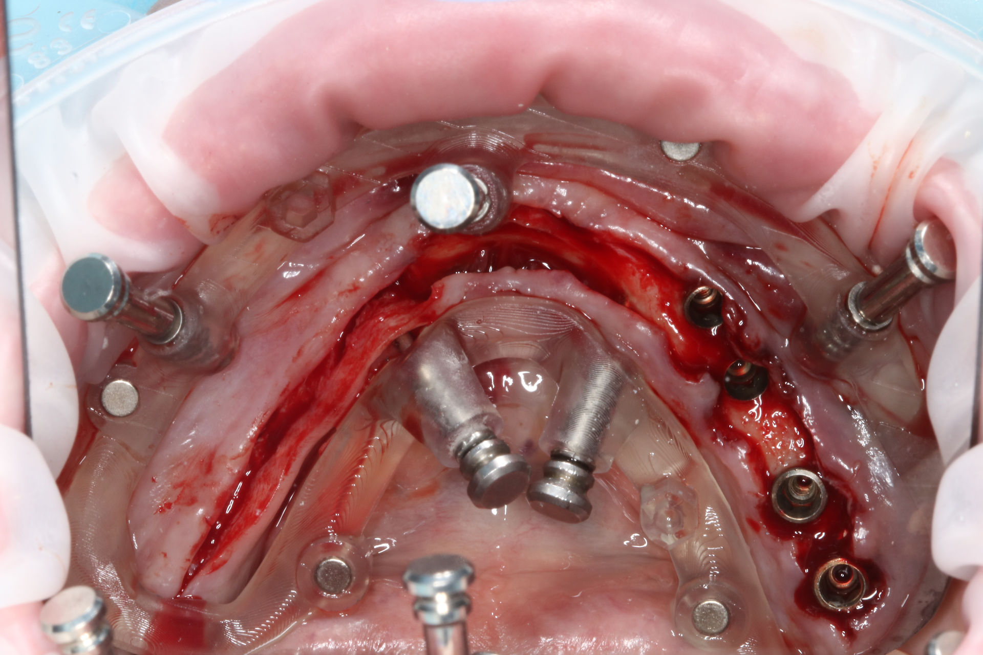 Mandibular surgical field with implants placed through the guided template