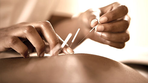 Acupuncture_edited.jpg