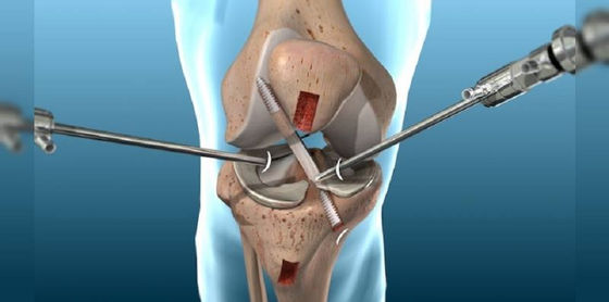 Knee Arthroscopy For Knee Injuries