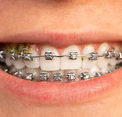 braces.jpg
