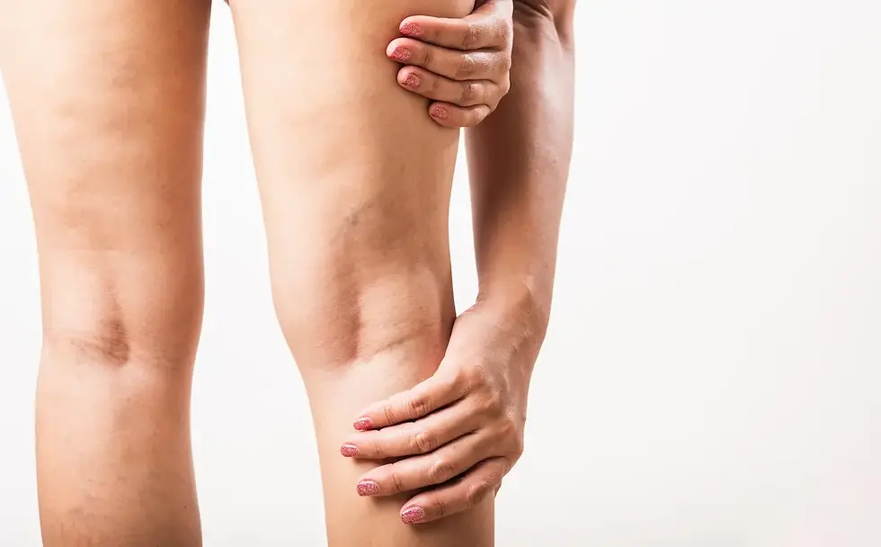 Provider examining spider veins on a patient's leg before sclerotherapy at The Spa by Sheena in Lubbock, TX