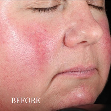 Before photo of a female patient treated with DermaV laser for rosacea facial redness and facial vessels.  