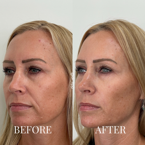 A woman's before and after results from comprehensive facial balancing with facial fillers (left-side).