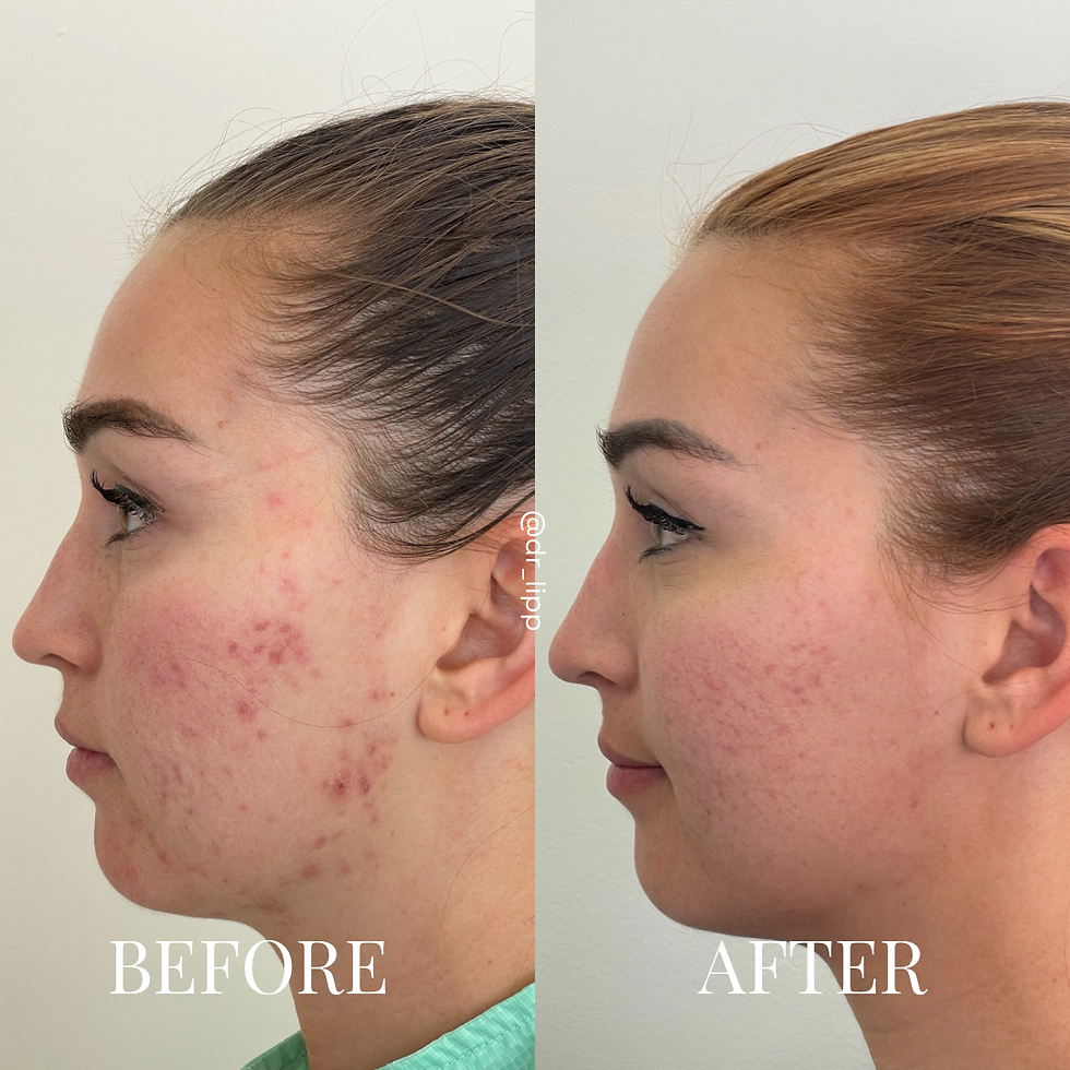 AviClear acne treatment results from SKINAESTHETICA. Results are after 3 treatments.