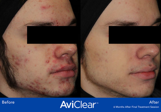 AviClear acne treatment: Before & After 6 months, showing clearer skin