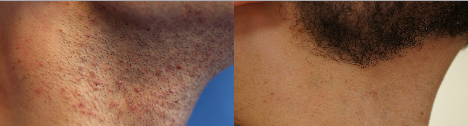 Laser Hair Removal Diode Ushr Technology Chiqcliniq Com Calgary