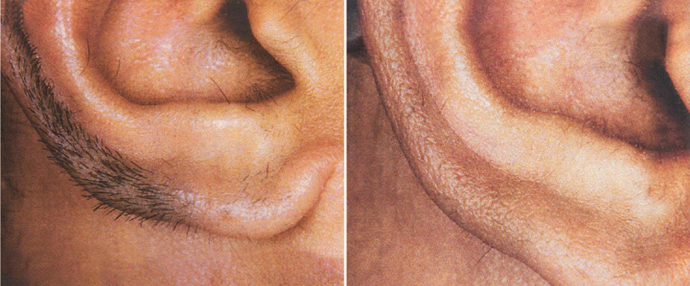Laser Hair Removal Diode Ushr Technology Chiqcliniq Com Calgary
