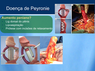 Doença de Pyronie - Curvatura Peniana Adquirida
