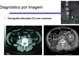 Cálculos urinários - atualização 2017: incidência aumenta e tratamentos pouco invasivos e modernos.