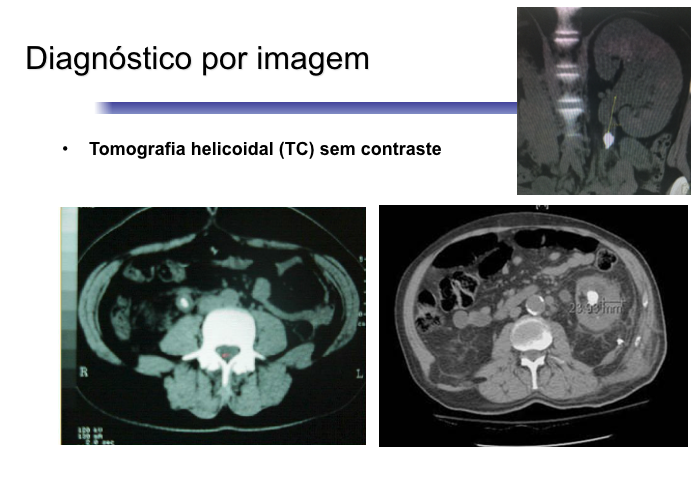 Tomografia para o diagnóstico dos cálculos urinários.