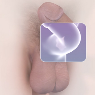 Doença de Peyronie - Tratamento não cirúrgico para tortuosidade peniana?