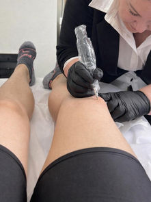 Stretch Mark and Scar Revision in Oakville: A Holistic Approach to Skin Regeneration